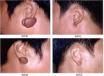 跟瘢痕疙瘩、皮膚血管瘤說拜拜--放射性核素敷貼治療