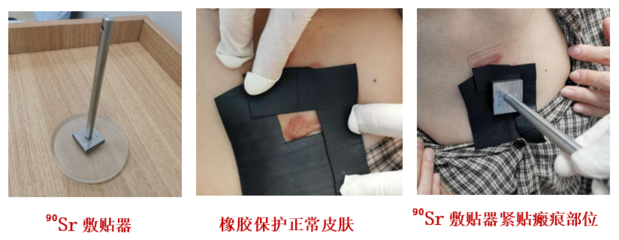 瘢痕疙瘩又丑、又癢、又痛怎么辦?它的&ldquo;克星&rdquo;來了