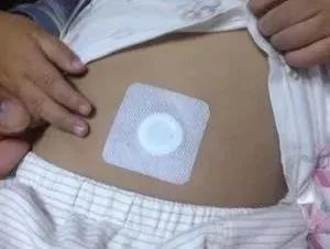 小兒積滯，秘密武器來幫你——敷貼器